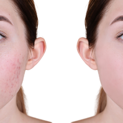 My_Facial_Skincare_Spa_for_Acne_Blemish_-_Florida_-_Weston_Doral_Aventura_Fort_Lauderdale