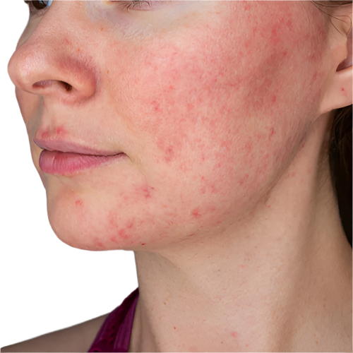 My_Facial_Skincare_Spa_for_Rosacea_-_Florida_-_Weston_Doral_Aventura_Fort_Lauderdale